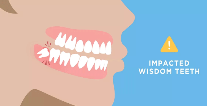 recovery for impacted wisdom teeth removal