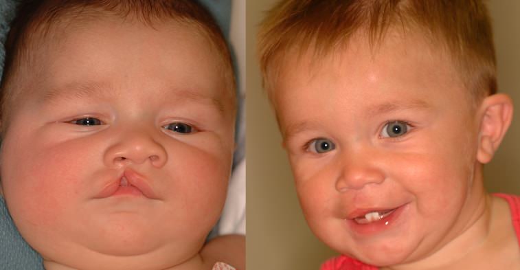 cleft lip and palate before and after