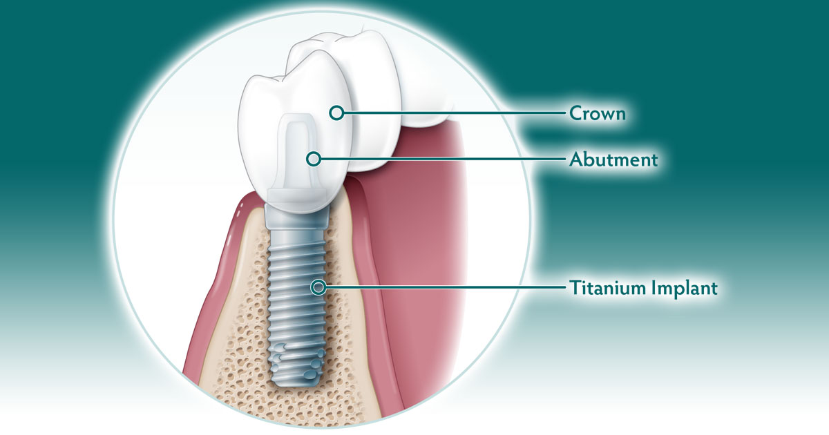 dental implants