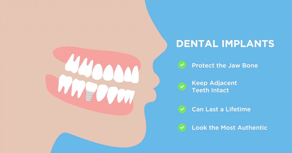 Are Dental Implants Safe