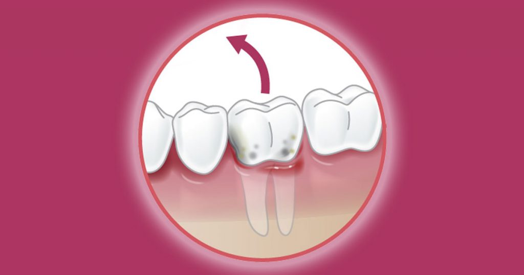 Tooth Extraction