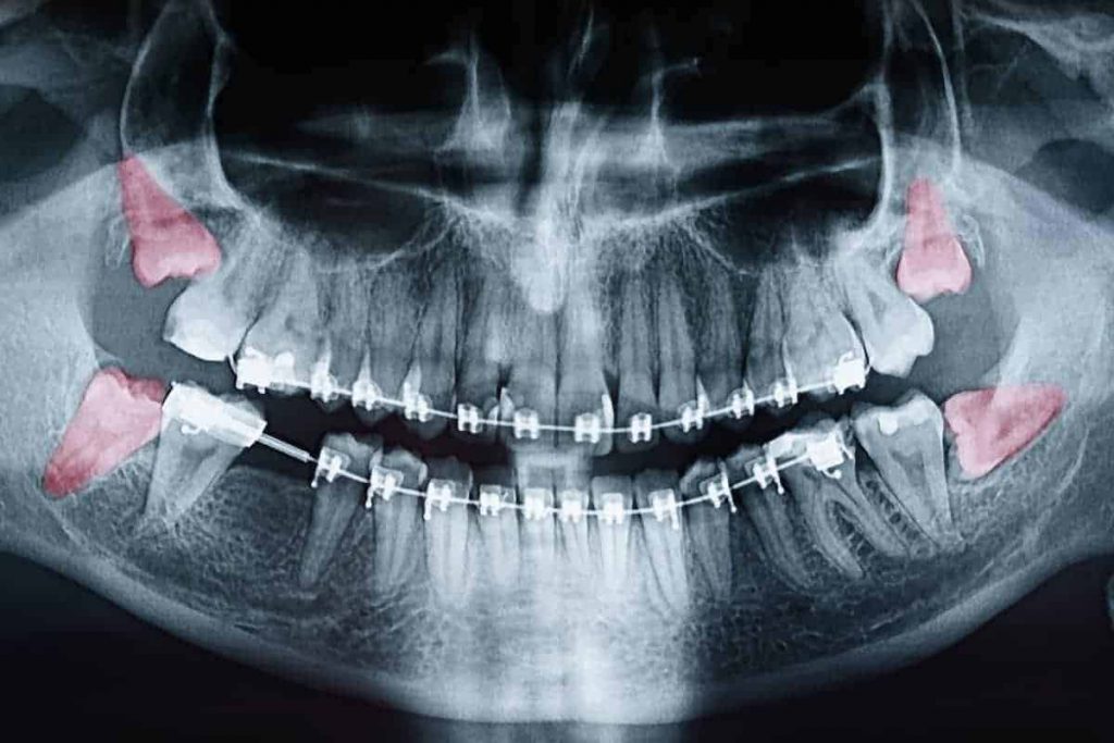 Why Monitor Wisdom Teeth