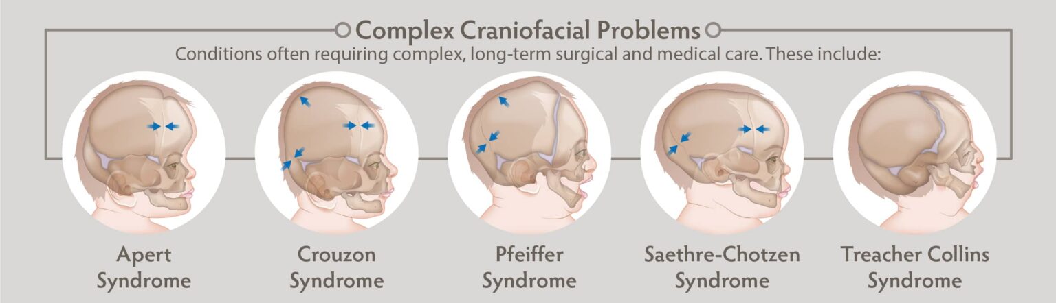 Craniofacial Surgeries