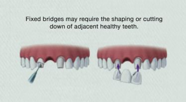 Dental Implant Surgery