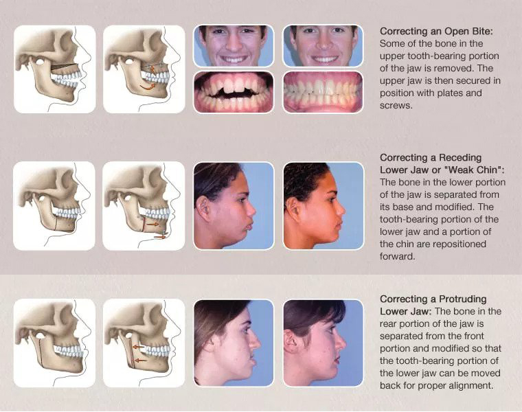 Correction of Common Dentofacial Deformities